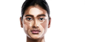Vitiligo Symptoms