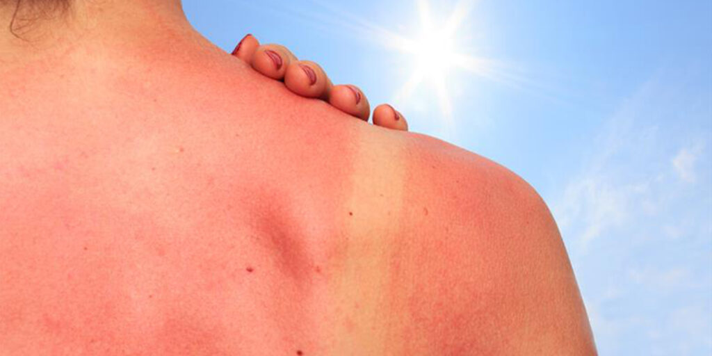 What is Sunburn