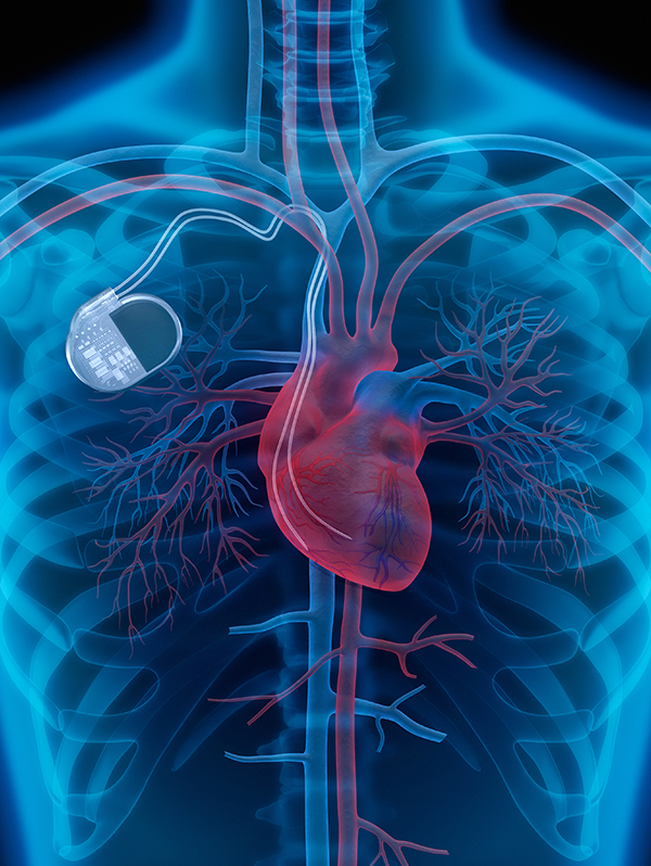Pacemaker Implantation