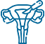 Hysterectomy