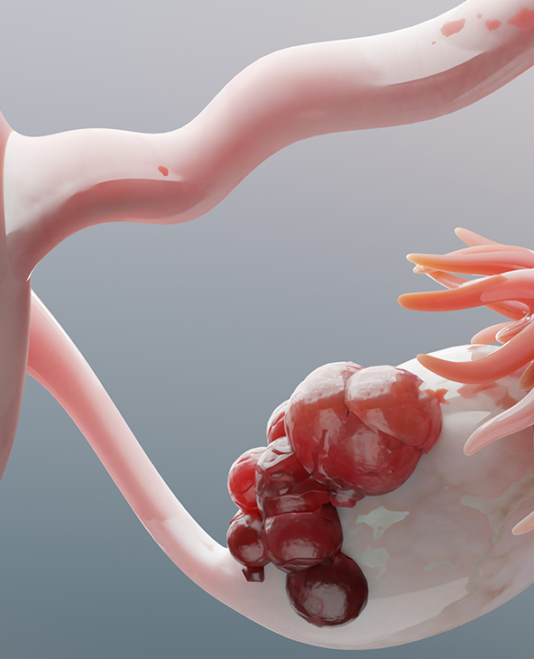 Ovarian Cyst Treatment in Dehradun