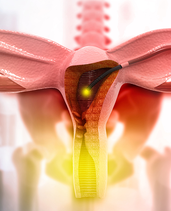 Myomectomy (Uterine Fibroids Surgery) in Dehradun