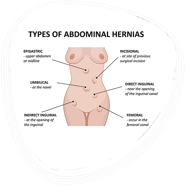 Why Choose Graphic Era Hospital for Hernia Treatment in Dehradun