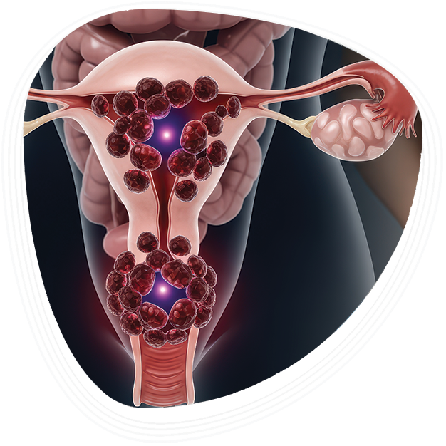 Why Choose Graphic Era Hospital for Uterine Fibroids Treatment
