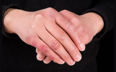 Chilblains on Fingers in Winter