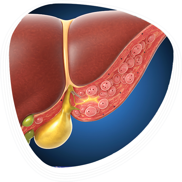 Choledochal-Cyst-Treatment-img2 Choledochal Cyst Treatment