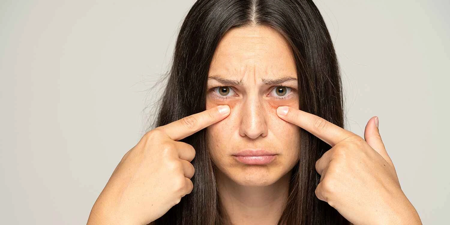 Puffy Eyes Explained: Causes, Home Remedies, and Medical Treatments