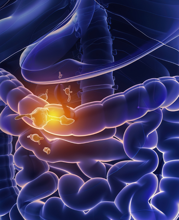 Whipple Procedure (Pancreaticoduodenectomy) in Dehradun
