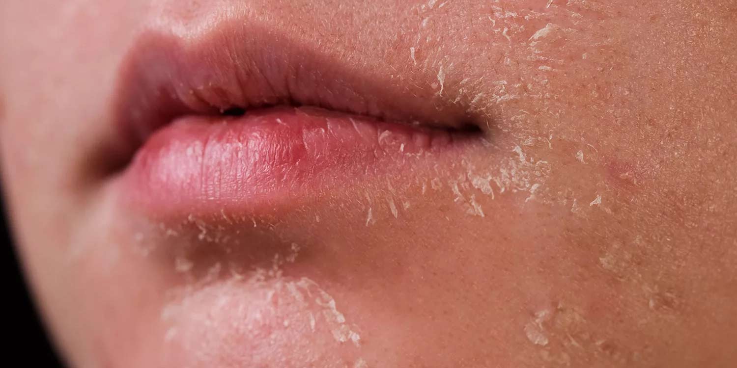 Dry Skin in Winter? Here’s Why It Happens and How to Treat It