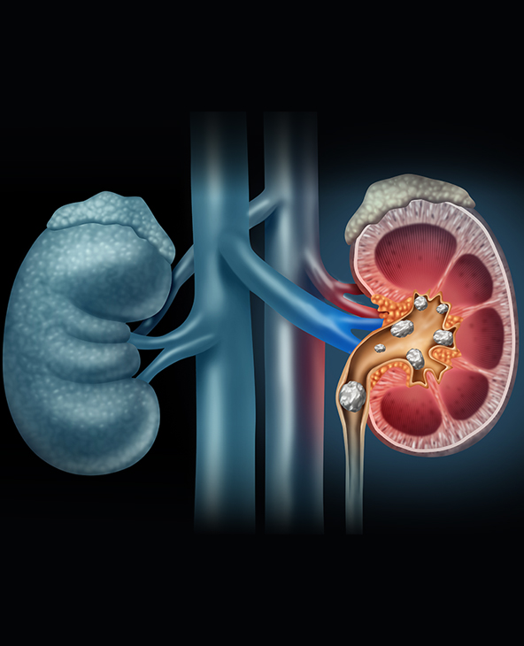 Kidney Stones (Nephrolithiasis) Treatment in Dehradun