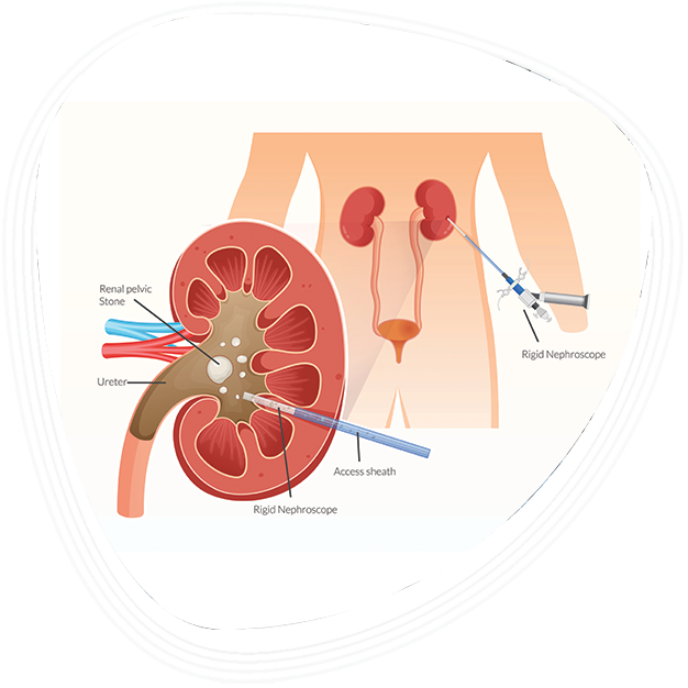 Why Choose Graphic Era Hospital for PCNL Surgery in Dehradun