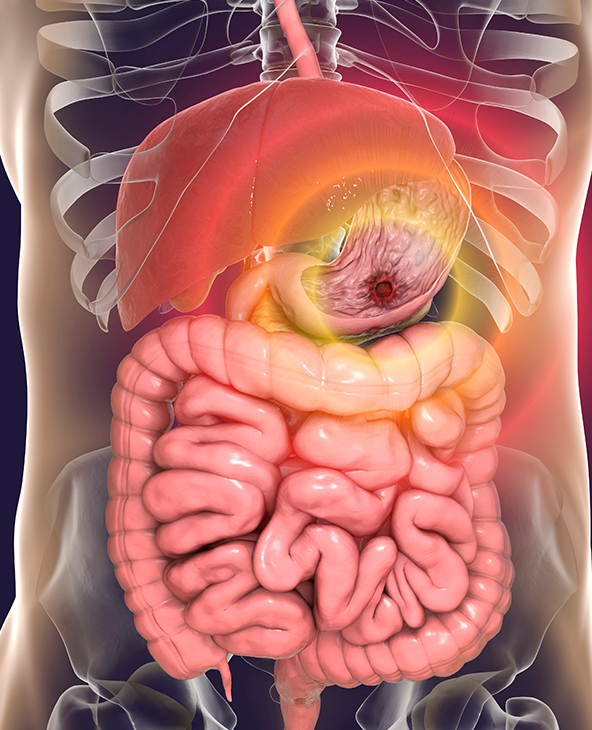 Peptic Ulcer Treatment in Treatment