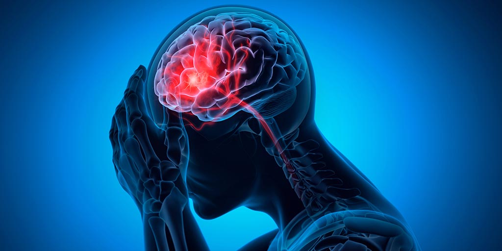 What is a Stroke: Causes, Symptoms & Treatment