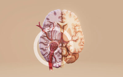Blood Clot in Brain