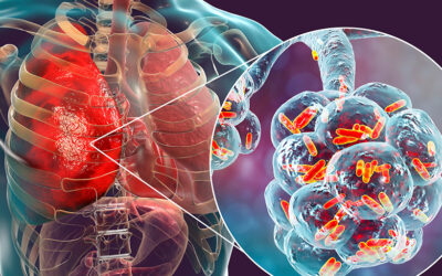 Viral vs Bacterial Pneumonia