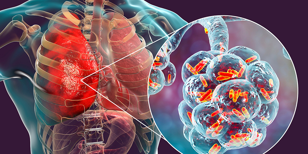 Bacterial and Viral Pneumonia: Causes, Symptoms, and Treatment Options