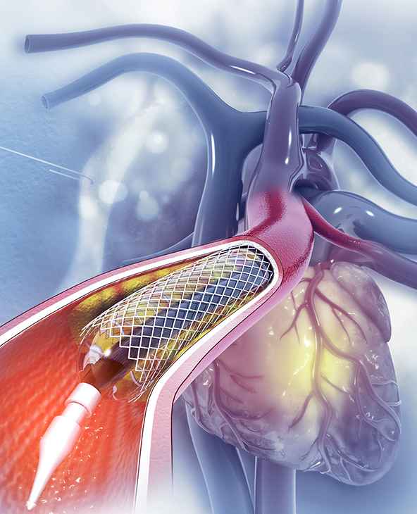 Angioplasty in Dehradun