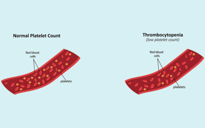 Low Platelet Count (Thrombocytopenia)
