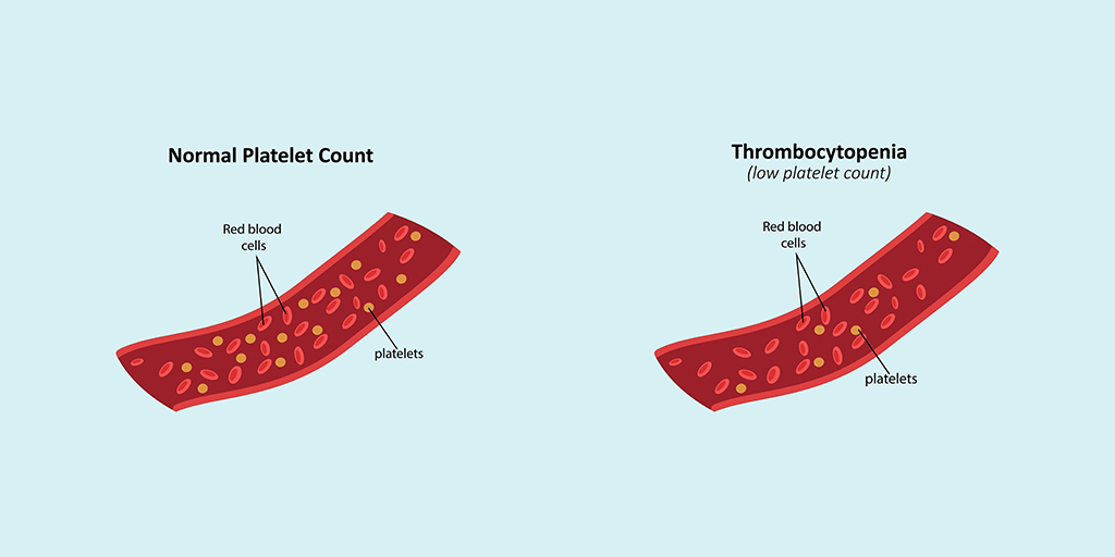 Low Platelet Count: Warning Signs That Need Medical Attention