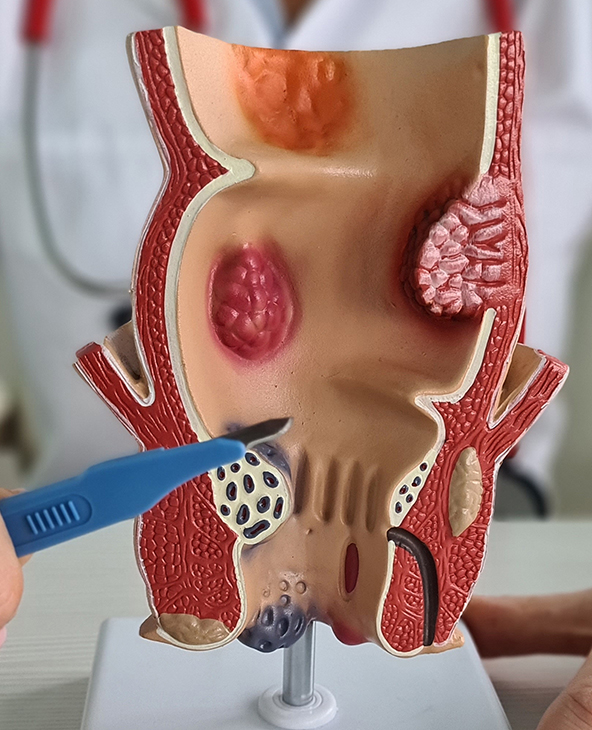 Piles (Haemorrhoids) Treatment in Dehradun