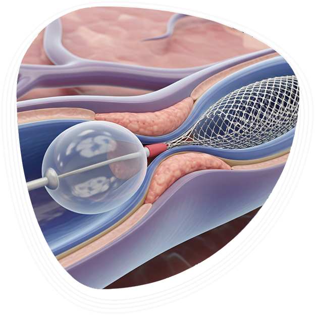 Why Choose Graphic Era Hospital for Angioplasty