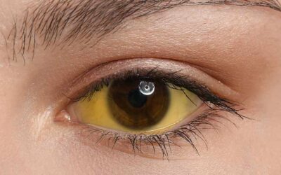 Yellow Eyes and Liver Health