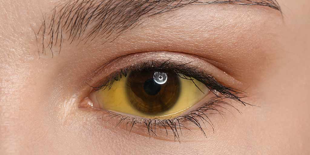 Yellow Eyes and Liver Health: What You Need to Know