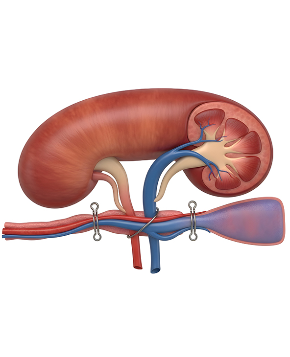 Pyeloplasty in Dehradun