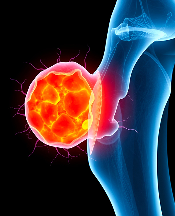 Sarcoma Treatment in Dehradun