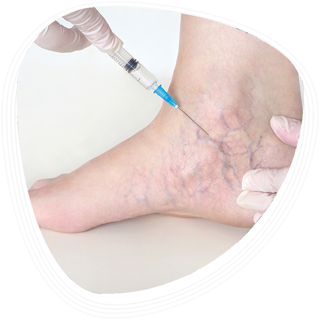 Why Choose Graphic Era Hospital for Sclerotherapy?