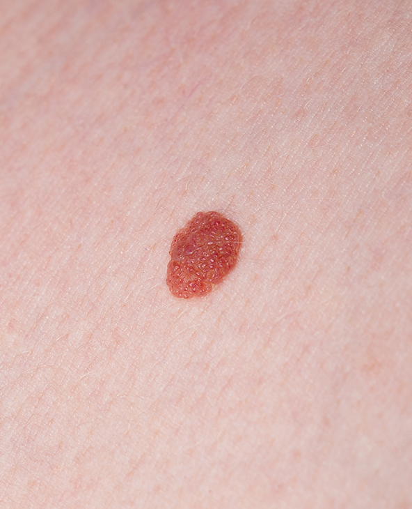 Hemangioma Treatment in Dehradun