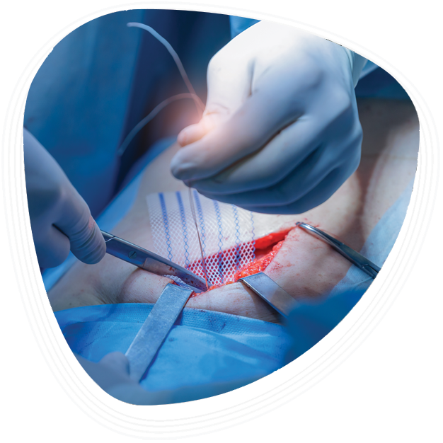 Why Choose Graphic Era Hospital for Hernia Repair Surgery