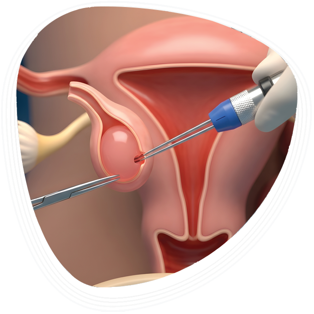 Why Choose Graphic Era Hospital for Ovarian Cyst Removal Surgery