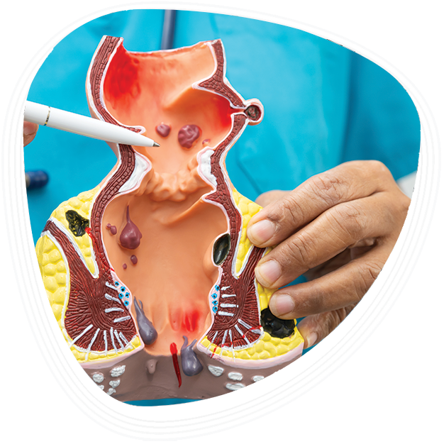 Why Choose Graphic Era Hospital for Piles Treatment