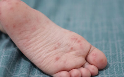 Hand, Foot, and Mouth Disease in Children