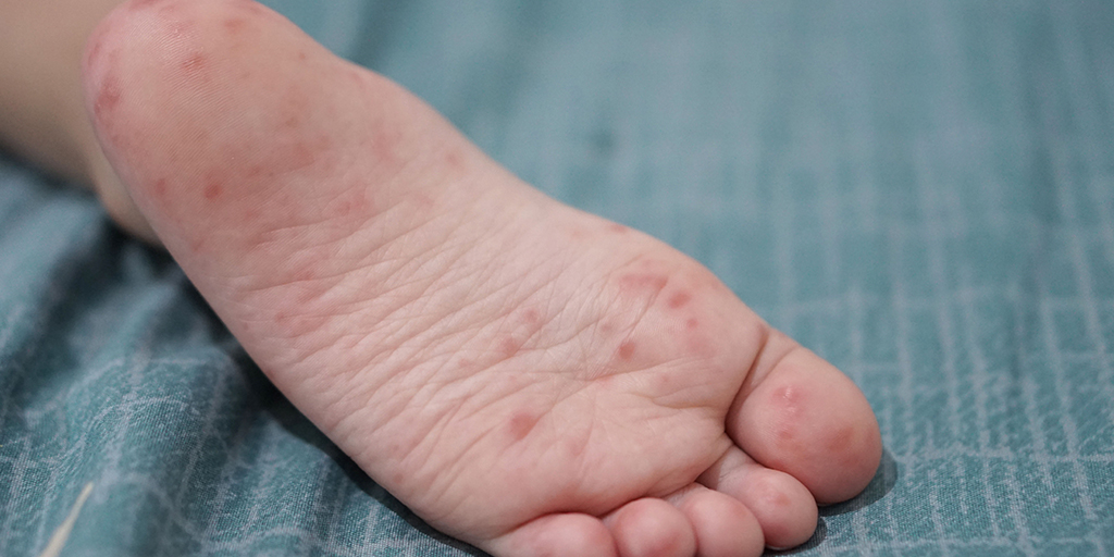 Hand, Foot, and Mouth Disease in Children: Symptoms, Transmission, and Home Care Tips for Parents