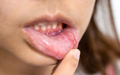 Mouth Ulcer Symptoms