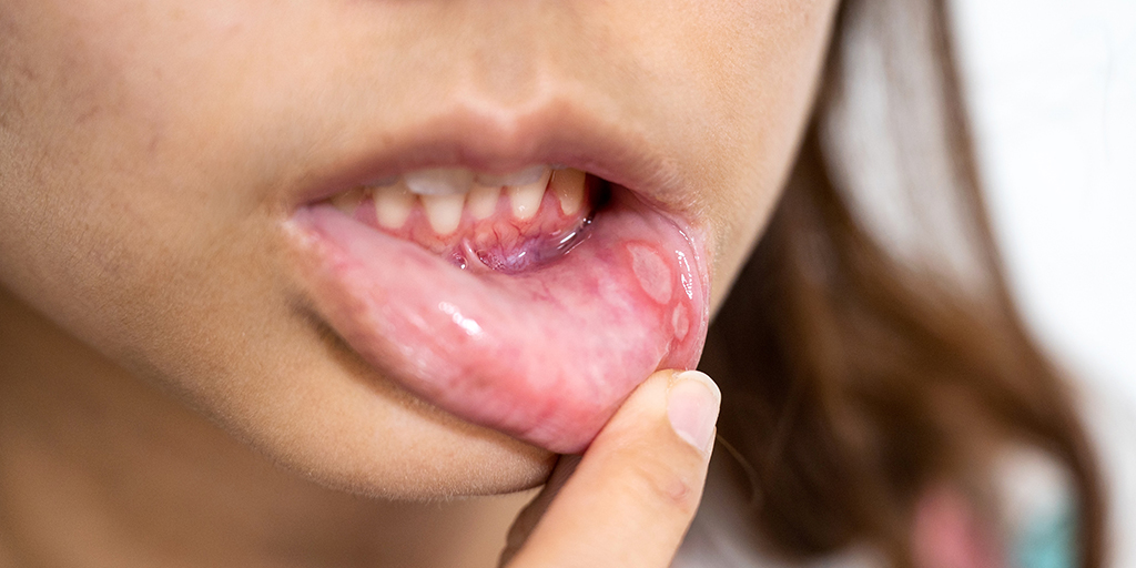 Mouth Ulcer or Something More Serious? How to Tell the Difference