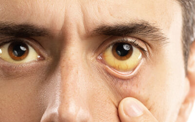 Signs and symptoms of jaundice