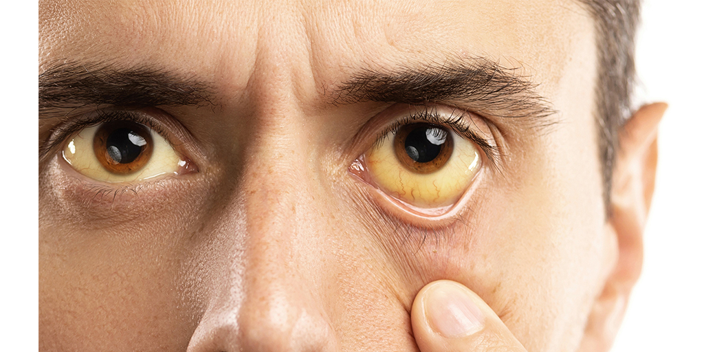 Treating Jaundice at Home: Common Myths vs. Medical Reality