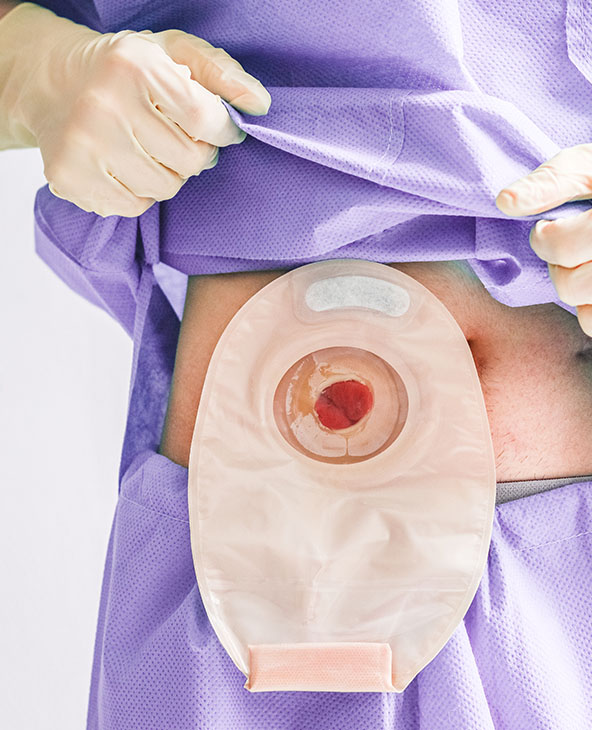 Umbilical Hernia Treatment in Dehradun