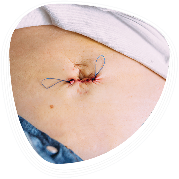 Why Choose Graphic Era Hospital, Dehradun, for Umbilical Hernia Treatment