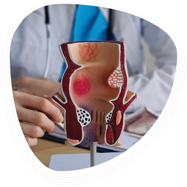 Why Choose Graphic Era Hospital for Anal Fissure Treatment