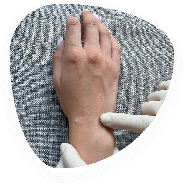 Why Choose Graphic Era Hospital for Cystic Hygroma Treatment in Dehradun
