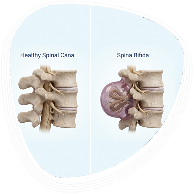 Why Choose Graphic Era Hospital for Spina Bifida Treatment in Dehradun